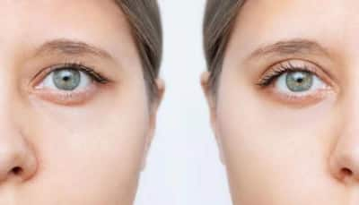 Blepharoplasty: The Rising Popularity Of Eyelid Lifting For A Rejuvenated Look