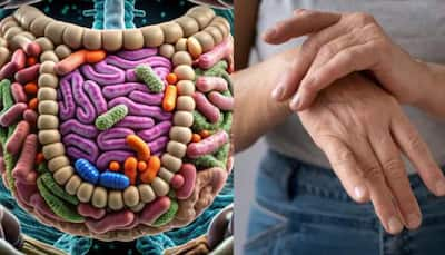 Study Links Gut Microbiome Changes To Early Onset Of Rheumatoid Arthritis