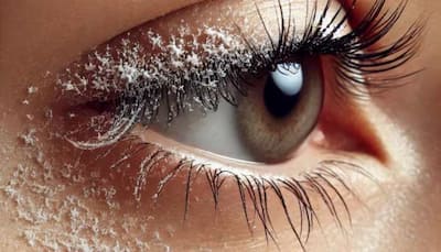 What Is Eyelash Dandruff? Know Common Symptoms, Risks, And Prevention; Check Expert Tips