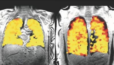 Breakthrough Lung Scan Method Shows Real-Time Effects Of Treatment And Transplant Function