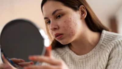 Can Pimple Breakouts Indicate Skin Cancer? Know Doc Says On This