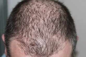 Low-Dose Antibiotics May Effectively Treat Rare Hair Loss Condition With Fewer Side Effects: Study