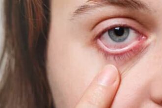 Spring Allergies And Dry Eyes: Causes, Symptoms, And Expert Tips To Protect Your Vision