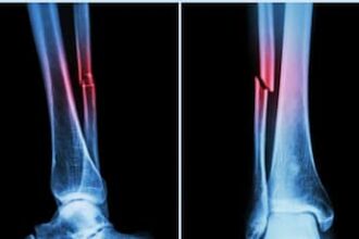 New AI Tool Detects Hidden Heart And Fracture Risks In Bone Scans Within Seconds, Say Scientists