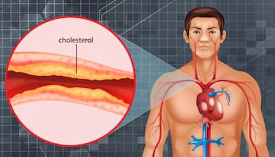 New Cholesterol-Lowering Pill Shows Promise In Cutting Heart Attack And Stroke Risk