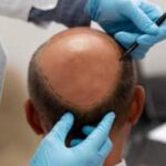 Botched Hair Transplant Surgery Kills Two Men In Kanpur: Expert Reveals What Went Wrong And How You Can Stay Safe