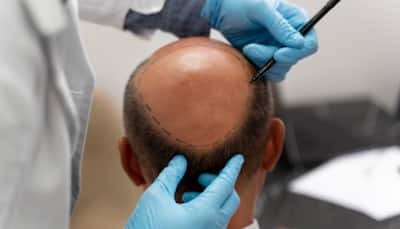 Botched Hair Transplant Surgery Kills Two Men In Kanpur: Expert Reveals What Went Wrong And How You Can Stay Safe