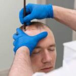 People Die During Hair Transplant Surgery? Doctor Shares Inputs On This