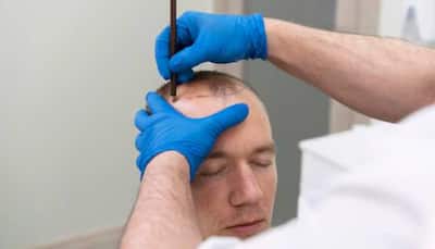 People Die During Hair Transplant Surgery? Doctor Shares Inputs On This