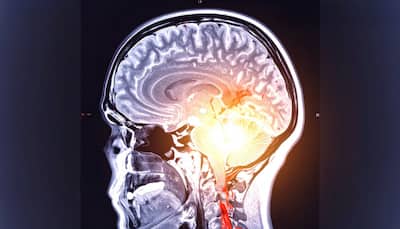 Oral And Gut Bacteria Linked To Worsening Dementia In Parkinson's: New Study Reveals Shocking Connection