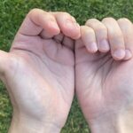 The health risks of being double-jointed