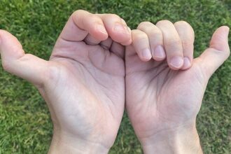 The health risks of being double-jointed