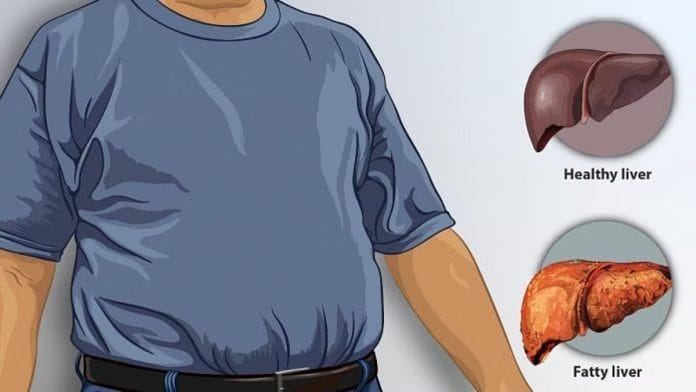 Fatty liver disease