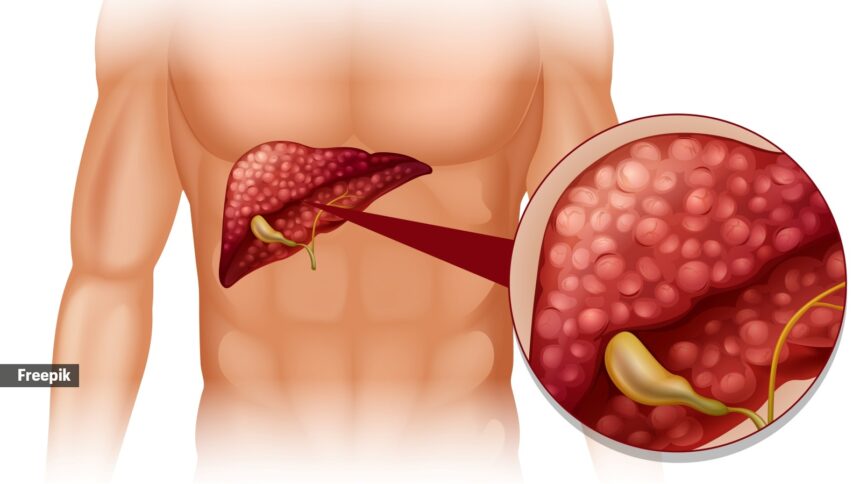 cirrhosis