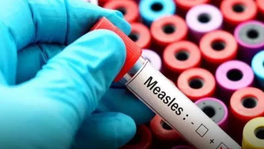 Bangladesh is facing a worsening measles outbreak, with more than 488 deaths and over 59,000 suspected infections reported across 58 districts. (File Photo)