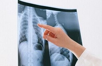 A pulmonologist has revealed that lung cancer is not confined to smokers.