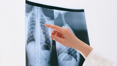 A pulmonologist has revealed that lung cancer is not confined to smokers.